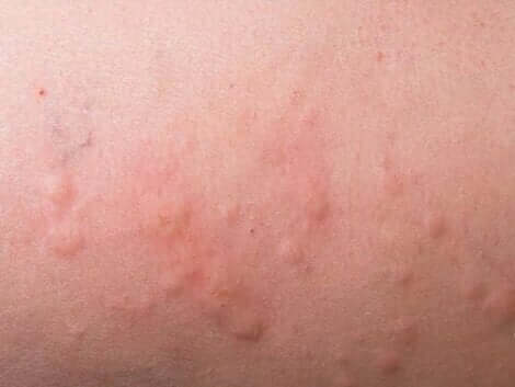 Uitslag als gevolg van roseola