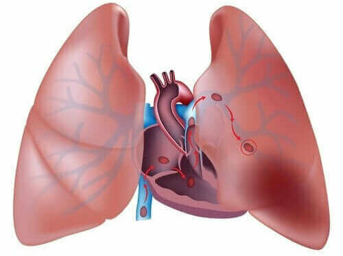 Alles wat je over pulmonale trombo-embolie moet weten