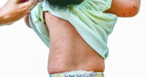 Roseola: wat is het en kun je het te voorkomen?