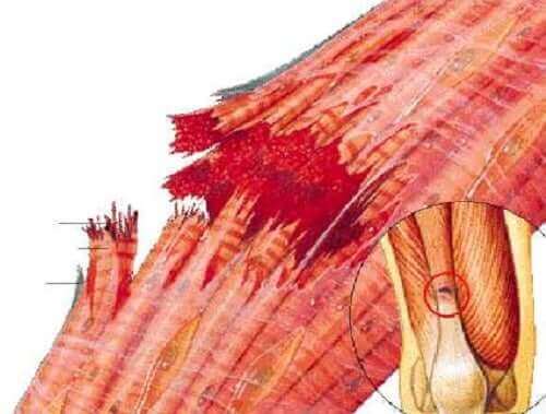 Uitvergroting van een scheur in een spier