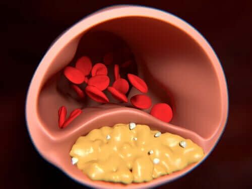 Arteriosclerose is een van de gevolgen van parodontitis