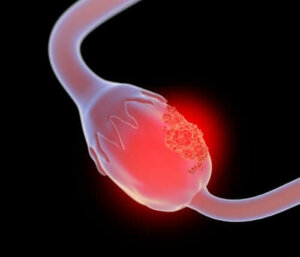 Wat is een ovarieel mucineus cystadenoom?