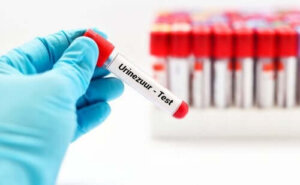 Hyperurikemie en hoe je urinezuurspiegels te verlagen