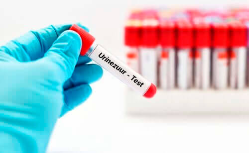 Hyperurikemie en hoe je urinezuurspiegels te verlagen