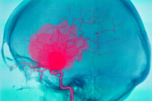 Wat is een intracerebrale bloeding precies?