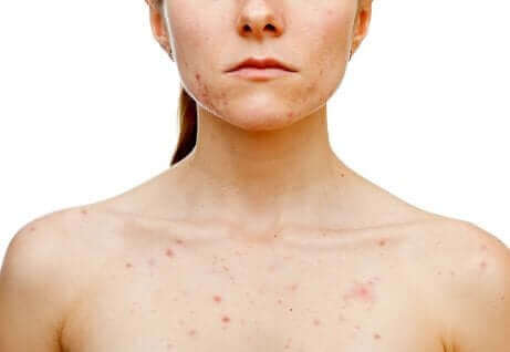 Vrouw met hormonale acne