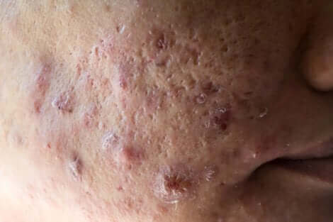 Littekens van hormonale acne