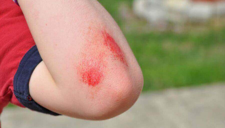 Elleboog met een schaafwond