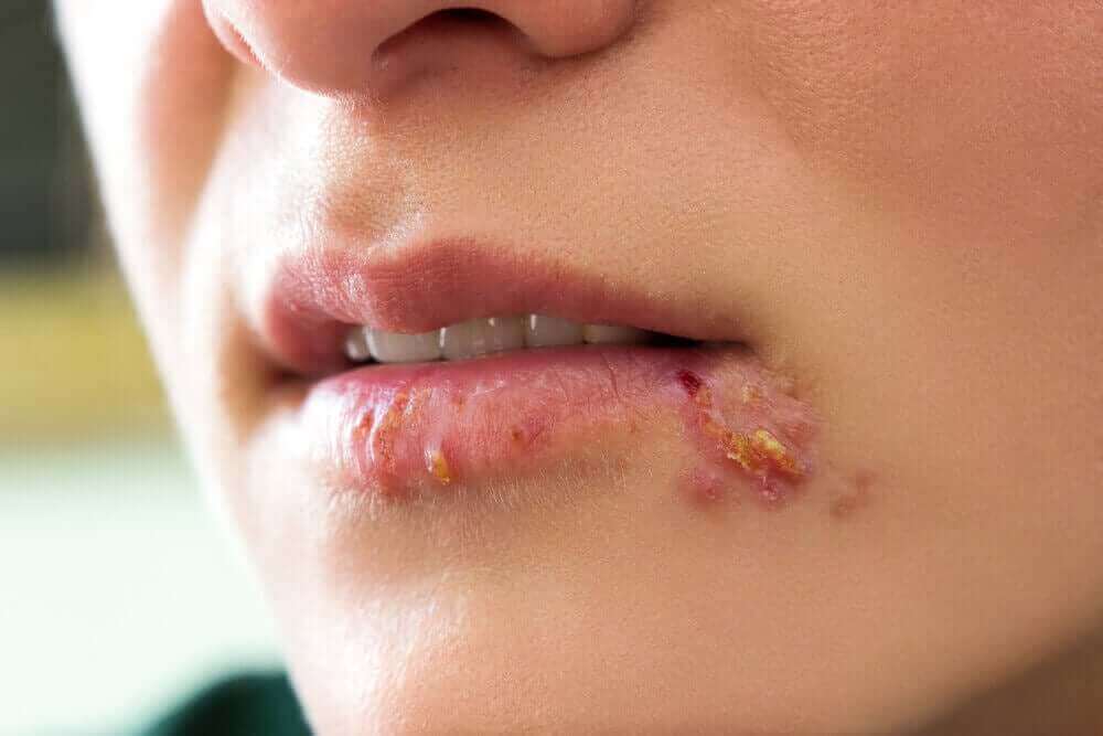Vrouw met het herpes zoster virus