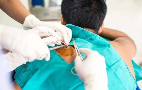 Artsen voeren een biopsie uit bij een man