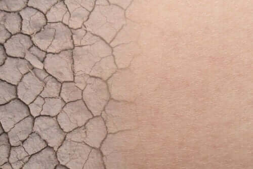 Close-up van een droge huid