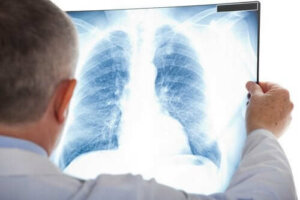 Een longembolie: symptomen en behandeling