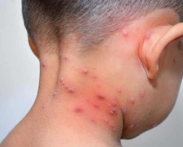 Staphylococcal scalded skin syndroom en de symptomen