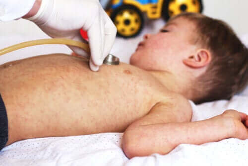 Staphylococcal scalded skin syndroom