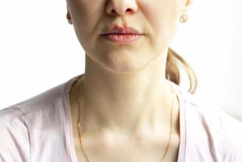 Een vrouw met pemphigus vulgaris