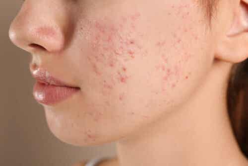 Vrouw met acne