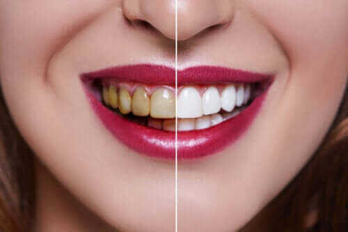 De oorzaken van verkleurde tanden