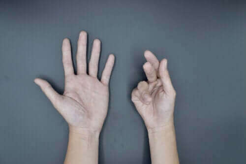 Behandelingen van de ziekte van Dupuytren