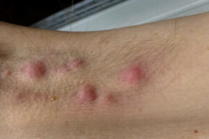 Kan een dieet hidradenitis suppurativa verbeteren?