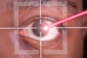 Voordelen en nadelen van een LASIK-operatie