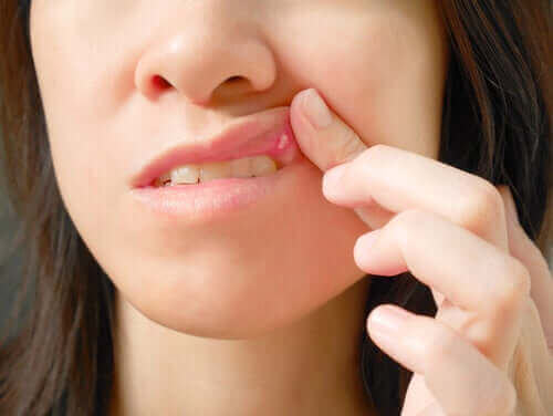Oorzaken van zweertjes in de mond en behandelingen
