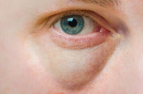 Oorzaken van gezwollen oogleden en behandelingen