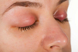 Symptomen en behandeling van een ooglidontsteking