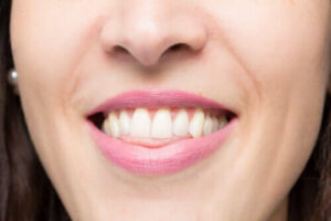 Wat is een open beet en hoe wordt deze gecorrigeerd?