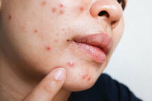 Isotretinoïne voor acne: voordelen en bijwerkingen