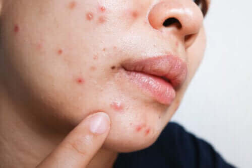 Isotretinoïne voor acne: voordelen en bijwerkingen