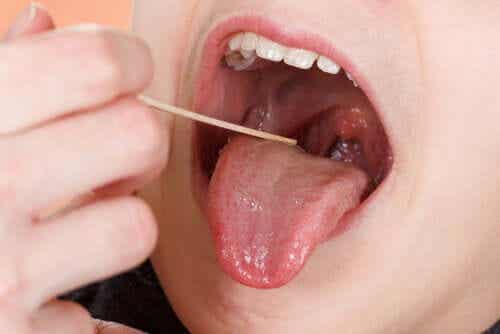 Ontstoken amandelen is een symptoom van faryngotonsillitis
