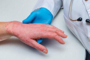 Psoriasis en coronaire hartziekte: zijn ze gerelateerd?