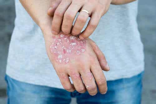 Hand met psoriasis