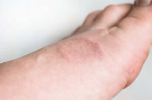 Symptomen en behandeling van granuloma annulare