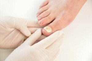7 manieren om schimmelnagelinfecties te voorkomen