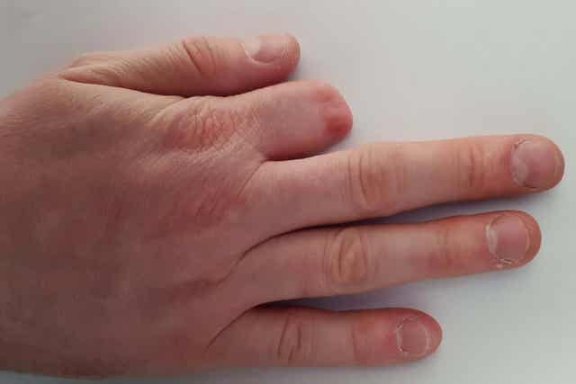 Hand waarvan de wijsvinger geamputeerd is