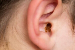 Kenmerken van een cerumen impactie