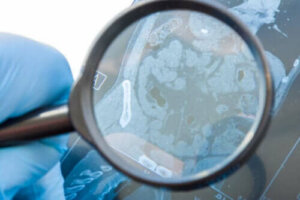 Wat is een gastro-intestinale fistel en wat is de oorzaak?