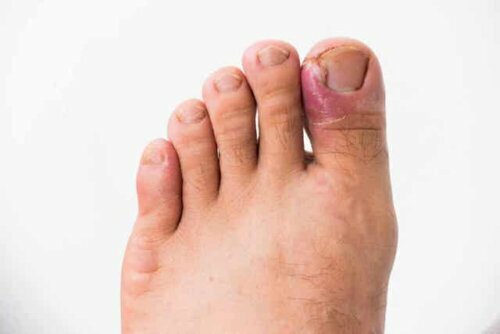 Voet met een schimmelnagelinfectie