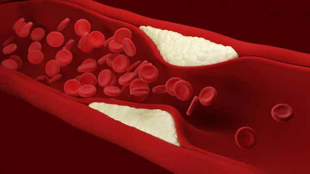 Atherosclerose