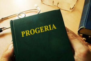 Het syndroom van Werner: te snel oud worden