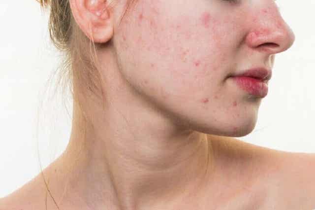 Vrouw met acne