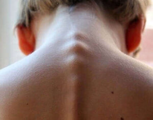 Symptomen, oorzaken en behandeling van myelitis transversa