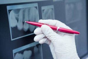 Wat is glazuurhypoplasie en hoe wordt het behandeld?