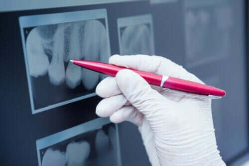Wat is glazuurhypoplasie en hoe wordt het behandeld?