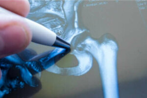 Alles wat je over heupfracturen moet weten