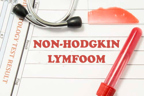 Non-Hodgkinlymfoom: alles wat je moet weten