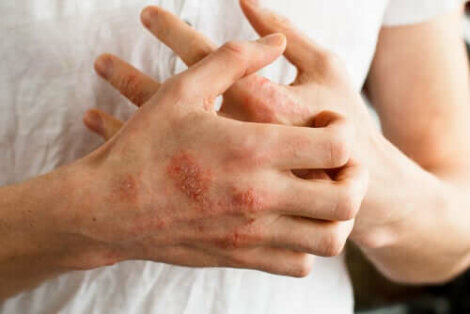 Protopic: een zalf voor atopische dermatitis