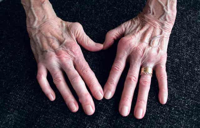 Reumatoïde artritis en wilde yam