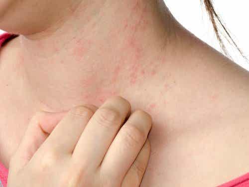 Protopic zalf voor atopische dermatitis